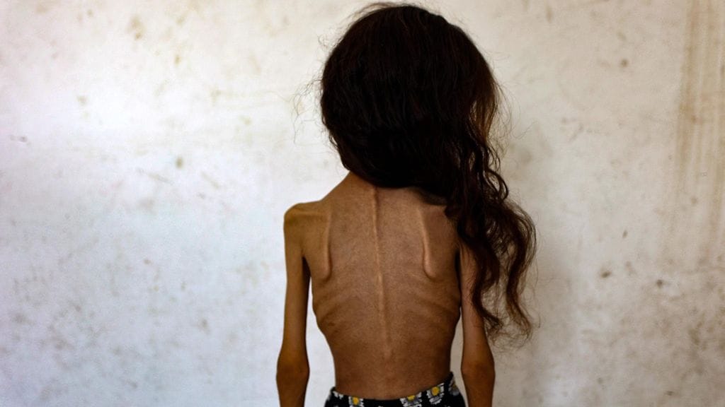 Yhdeksänvuotias aliravittu palestiinalaistyttö kuvattuna 2. elokuuta.