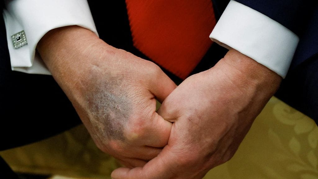Trump, käsi, mustelma