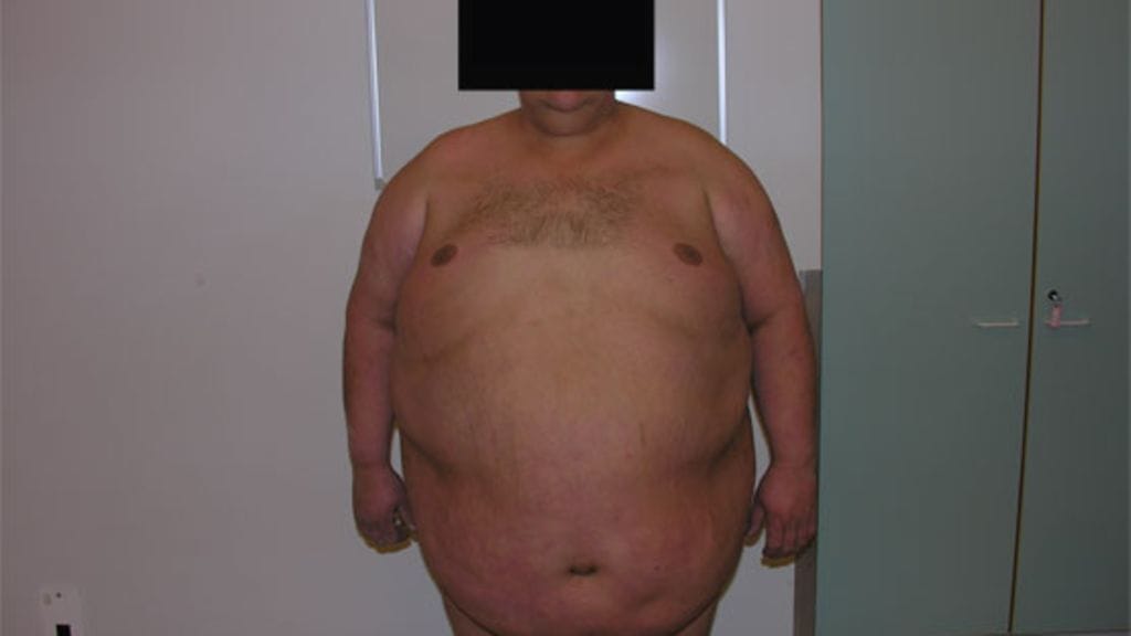 Lihavuusleikkauksella saadaan aikaan radikaaleja muutoksia.