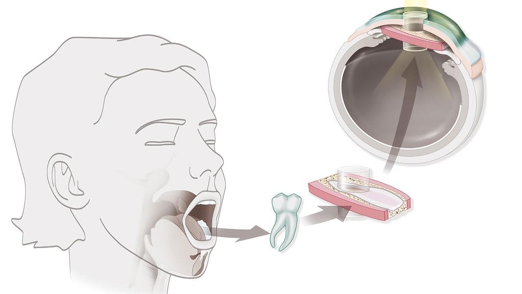 Chapmanin hampaasta rakennettu linssi siirrettiin hänen silmäänsä kesäkuussa, ja elokuussa viimeistelyleikkauksessa linssi suoristettiin.