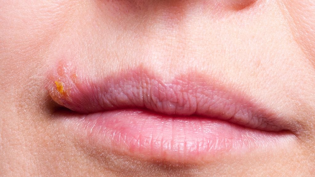 Valtaosa ihmisistä kantaa elimistössään herpesvirusta.