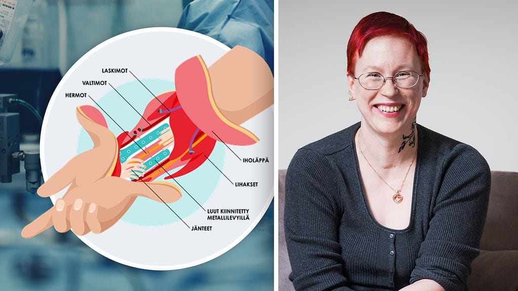 Arja Ahtaanluoma sai Suomen ensimmäisen käsisiirteen.