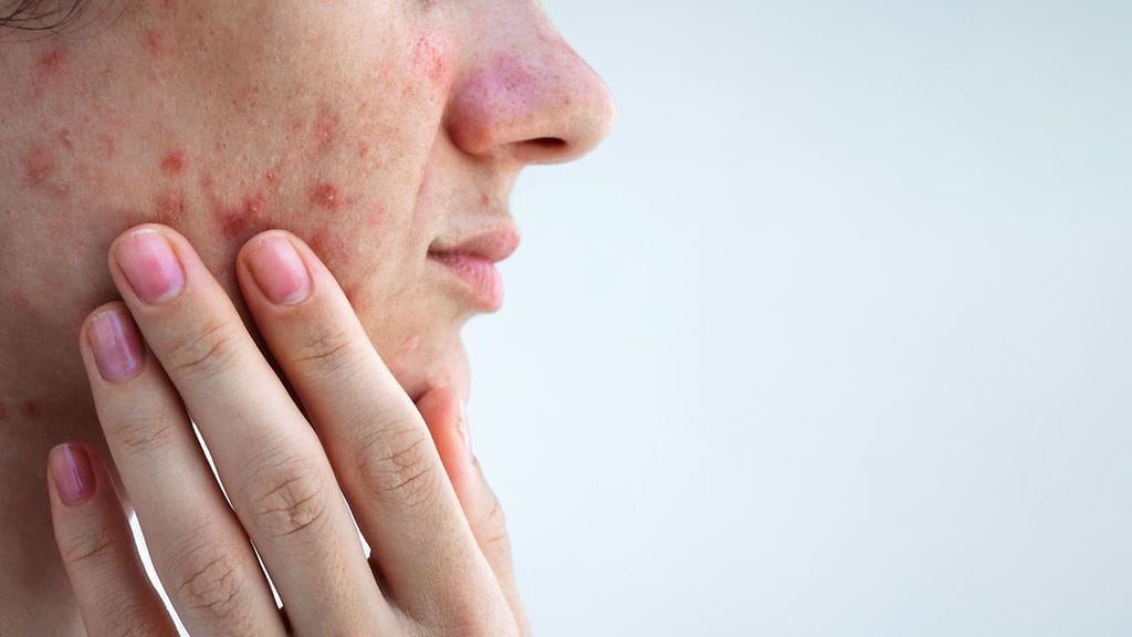 Liki kolmannes suomalaisista 35-vuotiaista naisista kärsii aknesta.