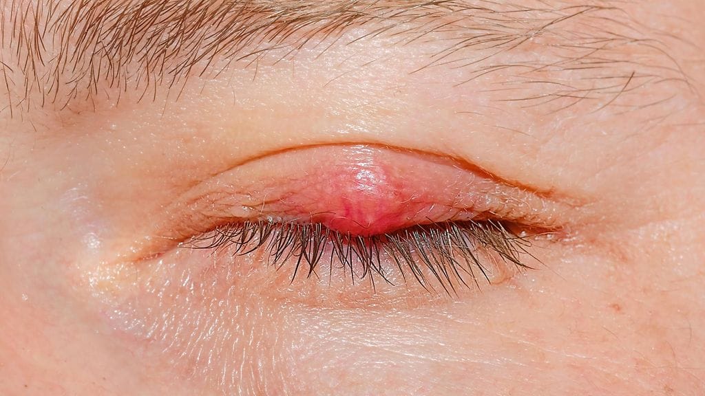 talipunkin aiheuttama tulehdus