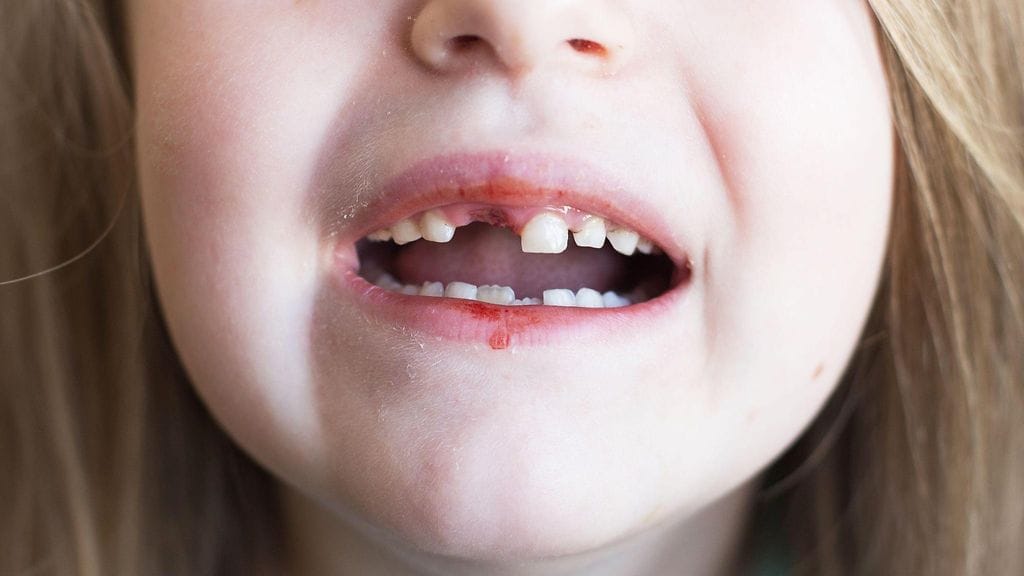 Kuvituskuva. Äiti ei pessyt poikansa hampaita puoleen vuoteen, mikä aiheutti lapsen suuhun mittavat vauriot.