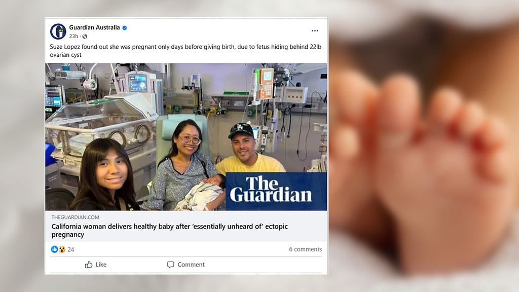 Kalifornialaisen naisen vauva kasvoi vatsaontelossa ja syntyi terveenä, kertoo The Guardian.