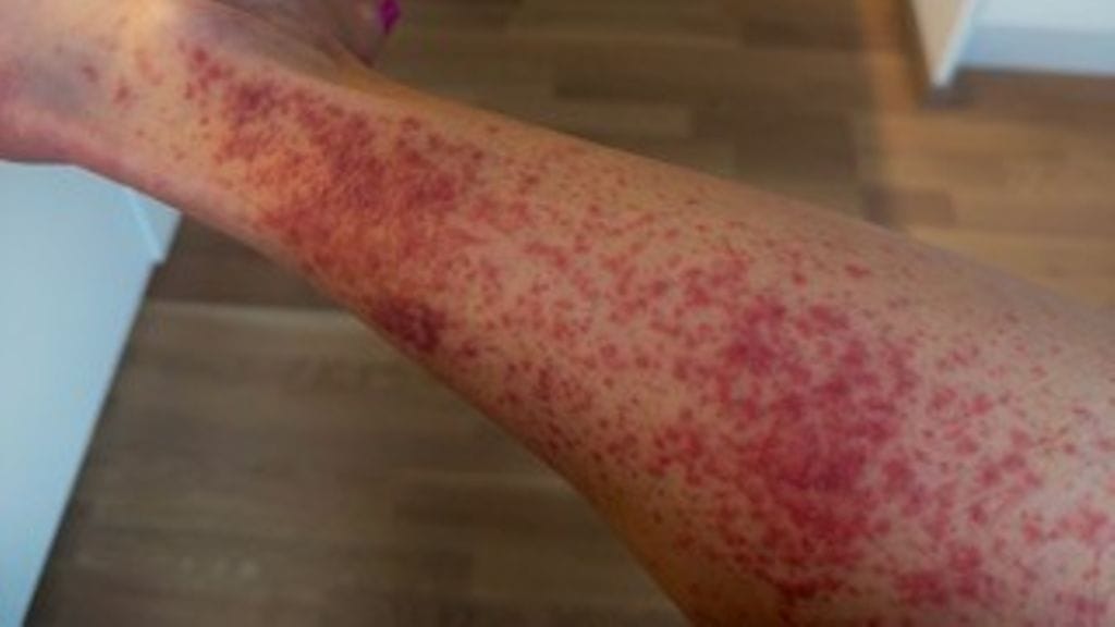 Wilma Rinkinen sai kesällä 2025 vakavan ihottuman Temusta tilatusta kuorimahanskasta. Kuvassa ihoreaktio jalassa.