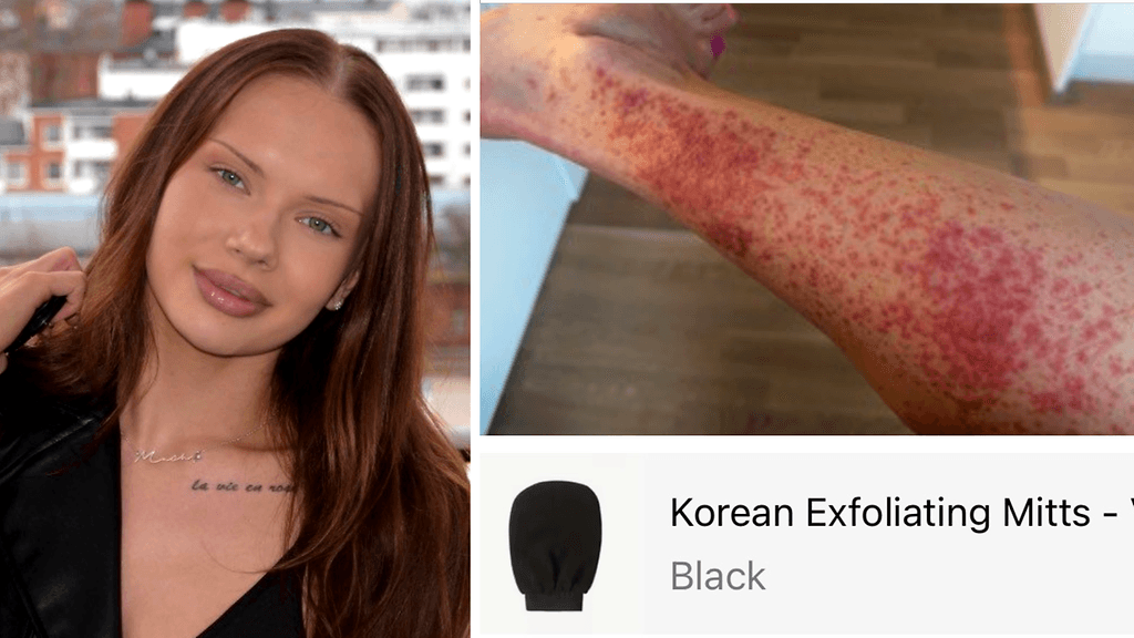 Wilma Rinkinen sai viime kesänä koko kehoon levinneen ihottuman Temusta tilatusta kuorintahanskasta.