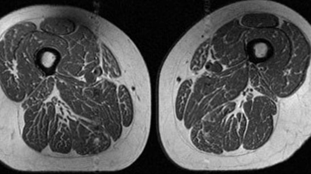 Näin "pihvimäiseltä" näyttävät lähinnä ultraprosessoitua ruokaa syövän 62-vuotiaan reidet magneettikuvassa. Kuva: Radiology