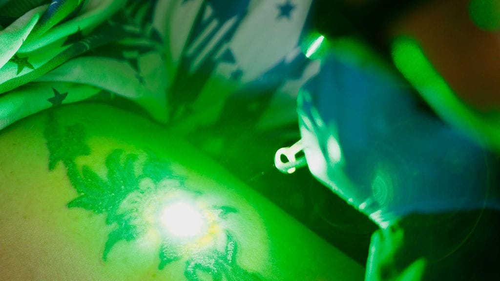 AOP Tatuoinnin poistoa laserilla Jakartassa.