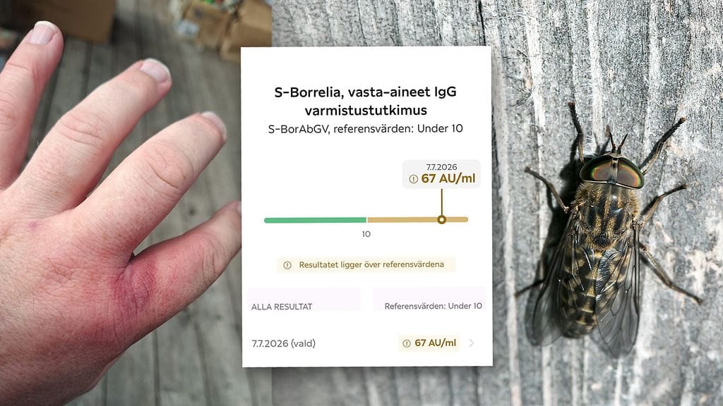 Espoolainen Anders Blomberg sai borrelioosin paarman puremasta.