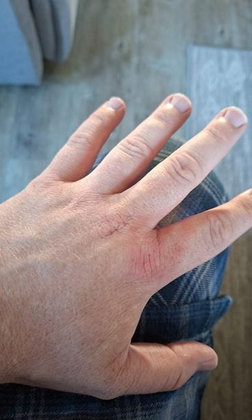 Espoolainen Anders Blomberg sai borrelioosin paarman puremasta 3