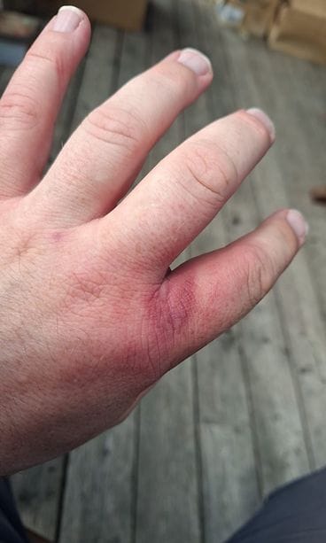Espoolainen Anders Blomberg sai borrelioosin paarman puremasta 4.