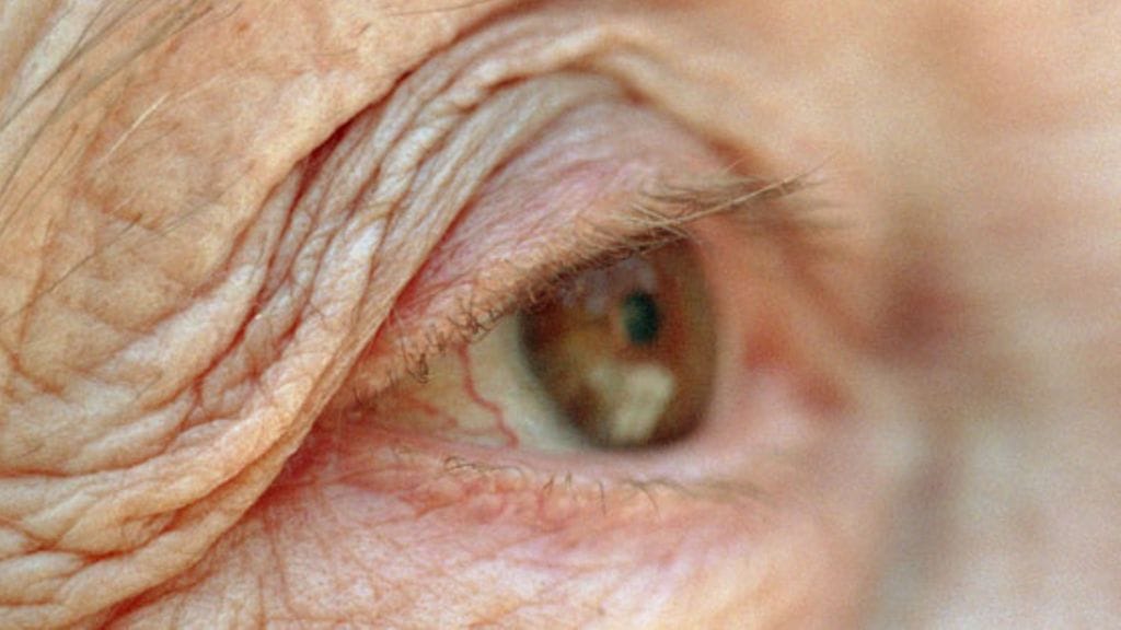 Silmätautien alan palveluiden kysyntää lisäävät niin harmaakaihi, glaukooma kuin silmänpohjan ikärappeumakin. Kuvituskuva.