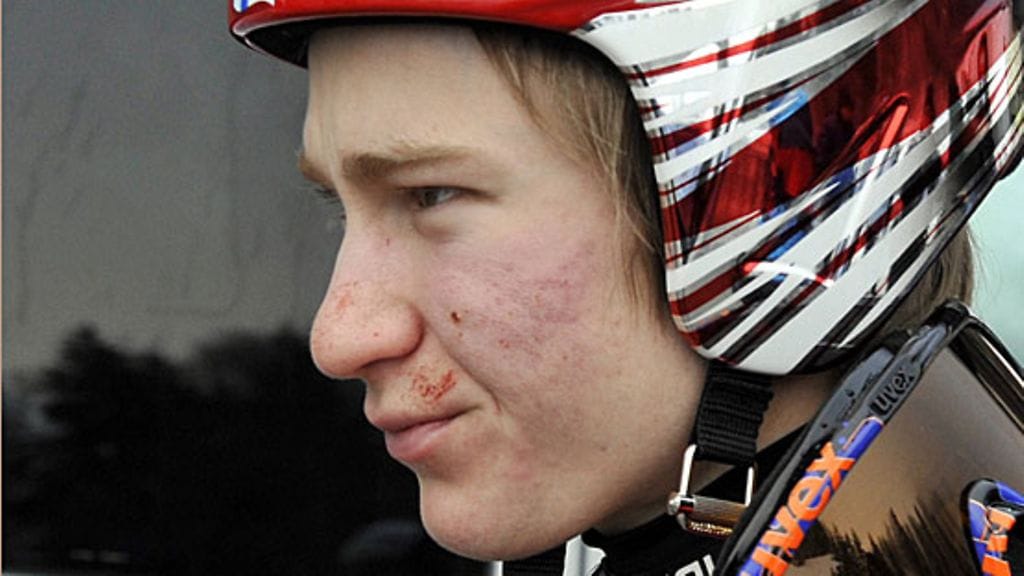 Ville Larinto kasvot naarmuilla kaatumisen jälkeen