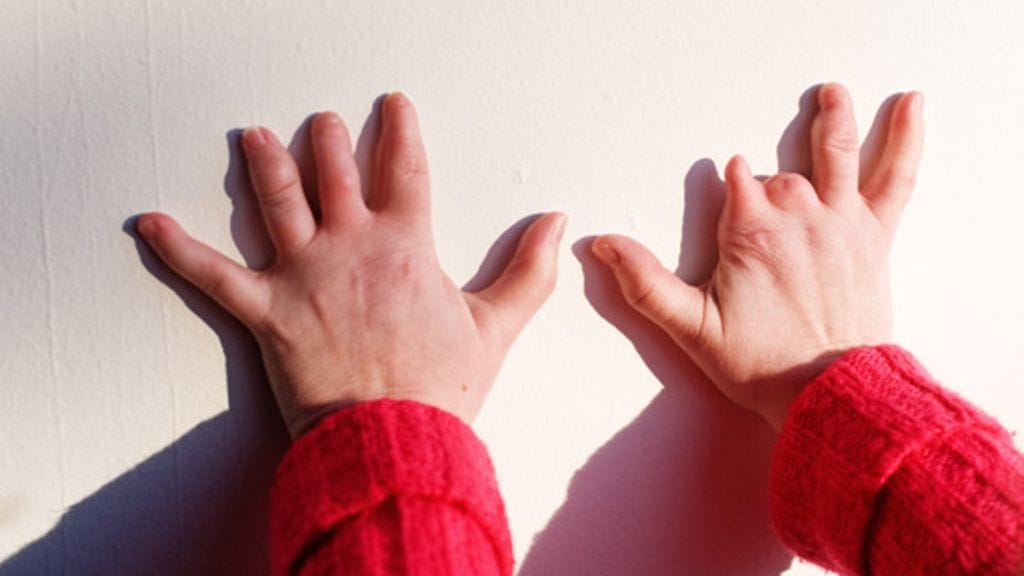 Röntgensäteet ovat jättäneet jälkensä Maria Amosen terveeseen jalkaan ja sormiin, joissa on epämuodostumia.