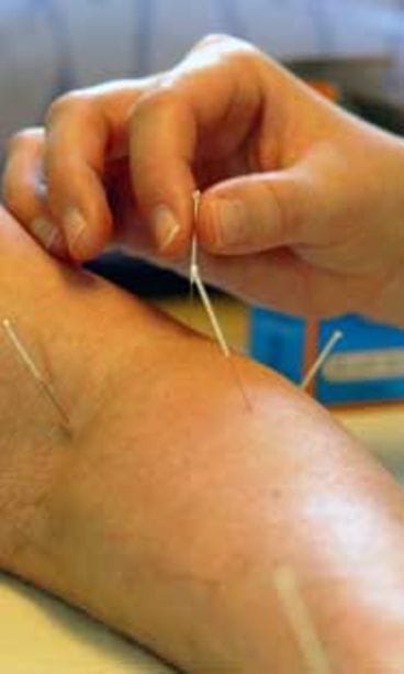 Nina ei uskonut akupunktion tehoon.