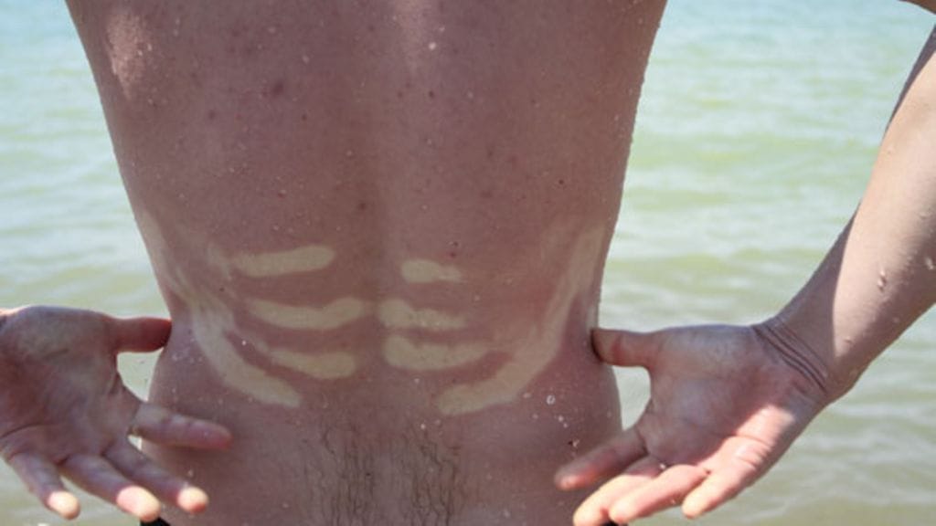 Aurinko tekee tuhojaan kesäihmisten iholle. Katso kuvat linkistä jutun alla.