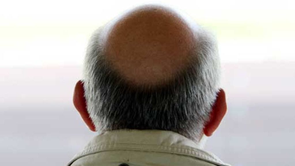 Kaljuuntumisen syistä on löytynyt uutta tietoa. Uusimpien tietojen mukaan kaljuillakin on hiuksia, tosin minimalistisen pieniä ja ohuita.